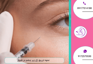 نحوه تزریق ژل زیر چشم در شیراز