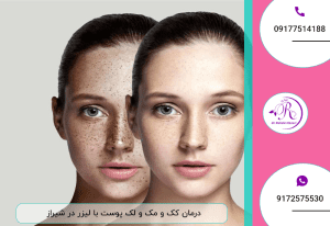 درمان کک و مک و لک پوست با لیزر در شیراز