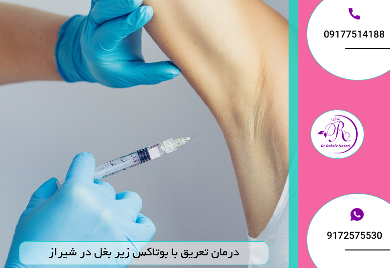 درمان تعریق با بوتاکس زیر بغل در شیراز