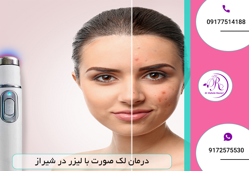 درمان لک صورت با لیزر در شیراز