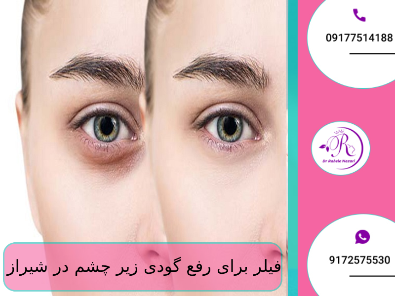 فیلر برای رفع گودی زیر چشم در شیراز