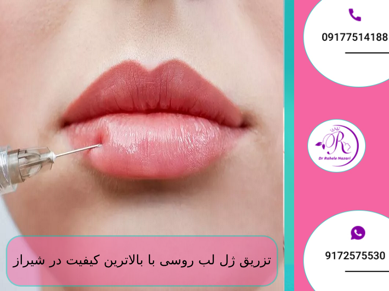 تزریق ژل لب روسی با بالاترین کیفیت در شیراز