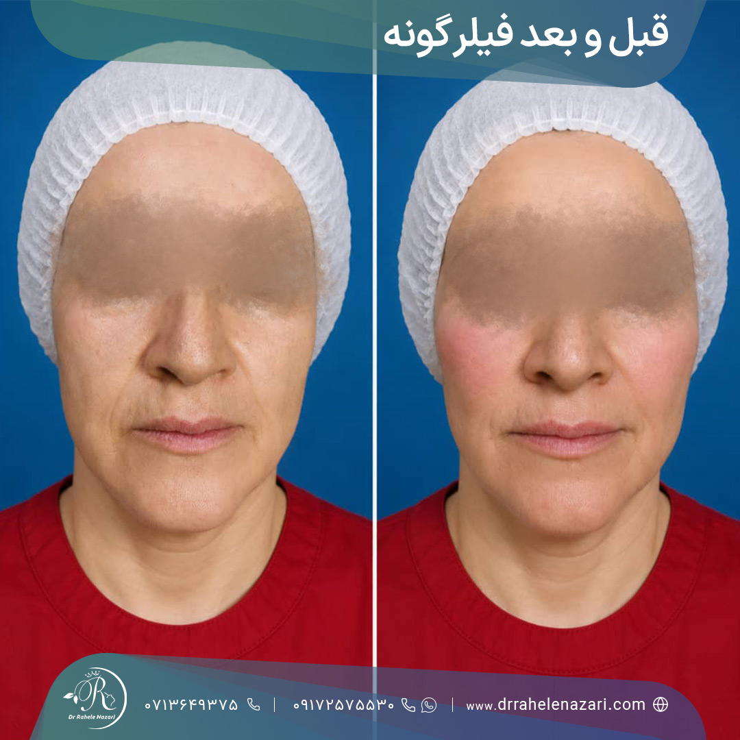 تزریق گونه و لیفت گونه با تکنیک ام دی کد تزریق گونه و لیفت گونه با تکنیک ام دی کد