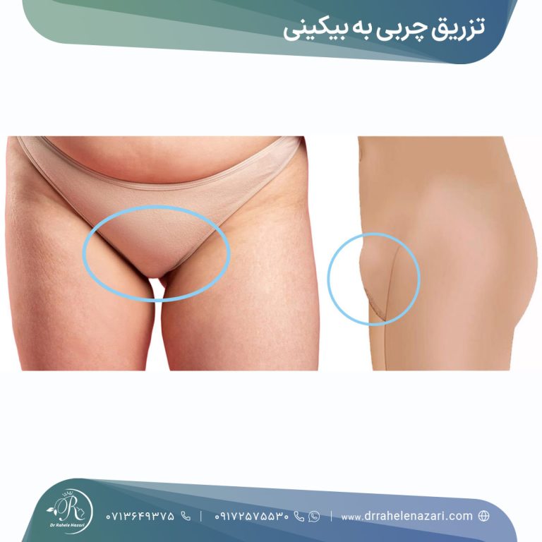 تزریق چربی بیکینی شیراز