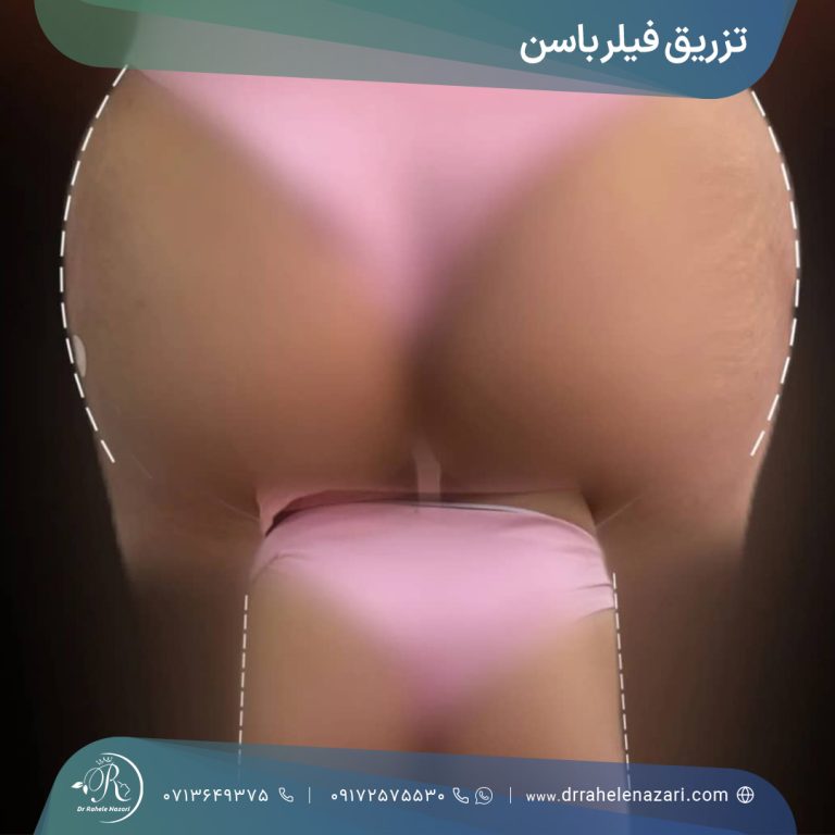 تزریق فیلر باسن شیراز