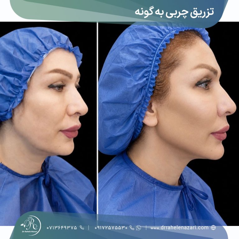 تزریق چربی گونه شیراز