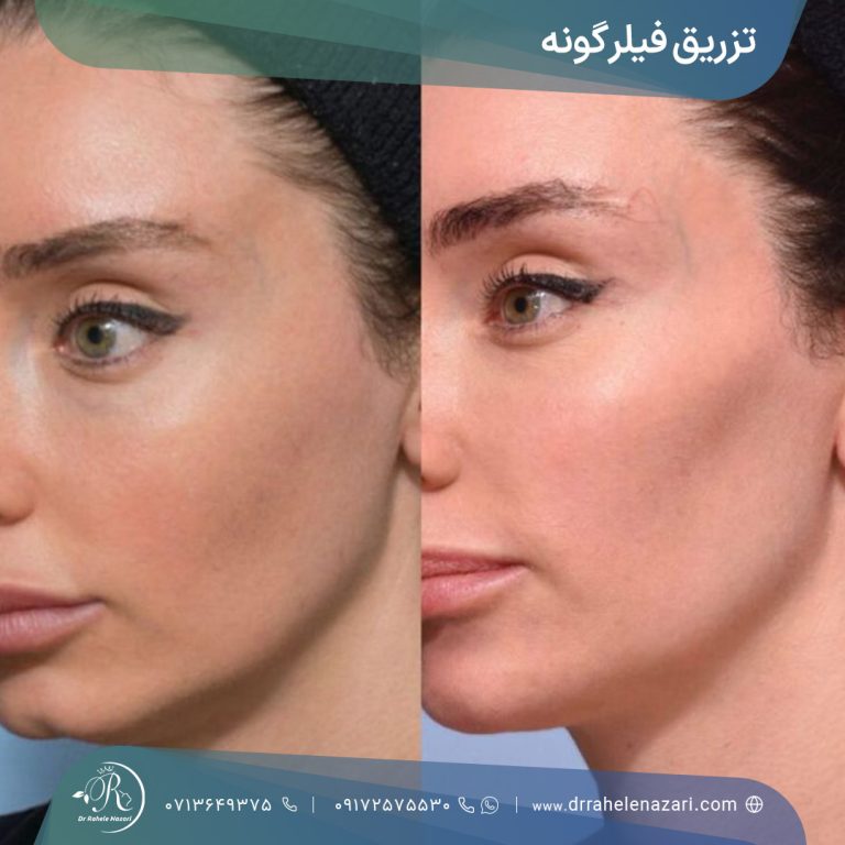 تزریق فیلر گونه شیراز