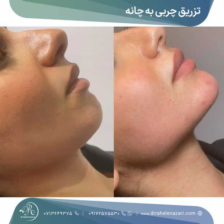 تزریق چربی چانه شیراز