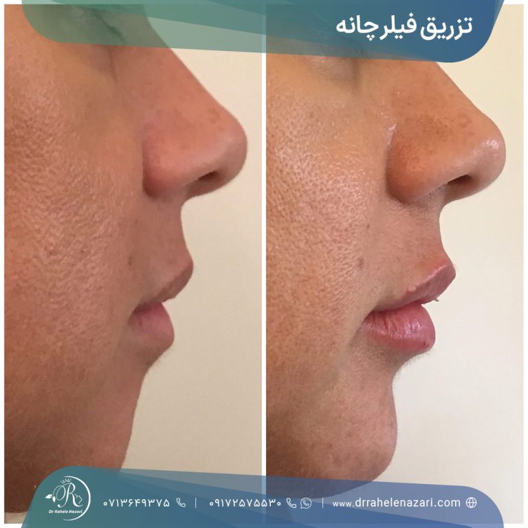 تزریق فیلر چانه شیراز