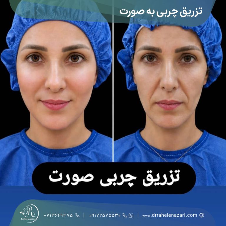 تزریق چربی به صورت شیراز