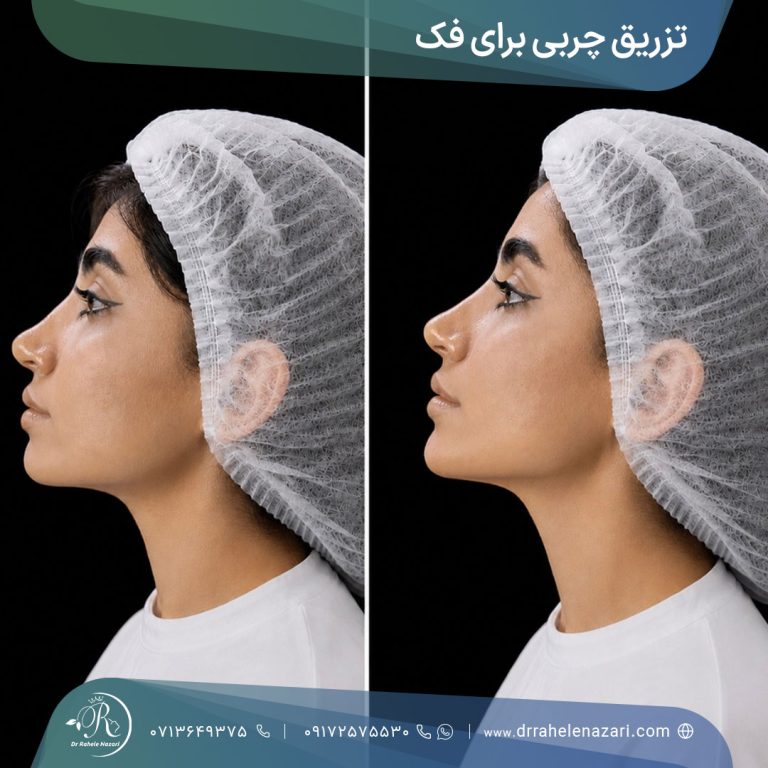 تزریق چربی برای زاویه سازی فک شیراز