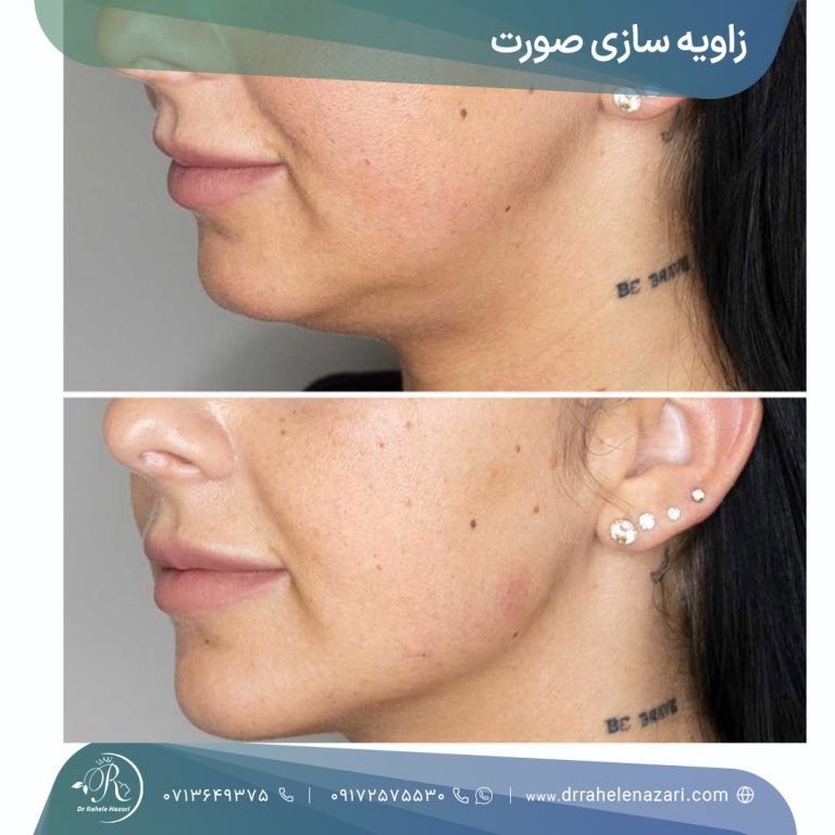 زاویه سازی صورت شیراز
