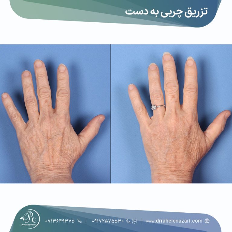 تزریق چربی دست شیراز