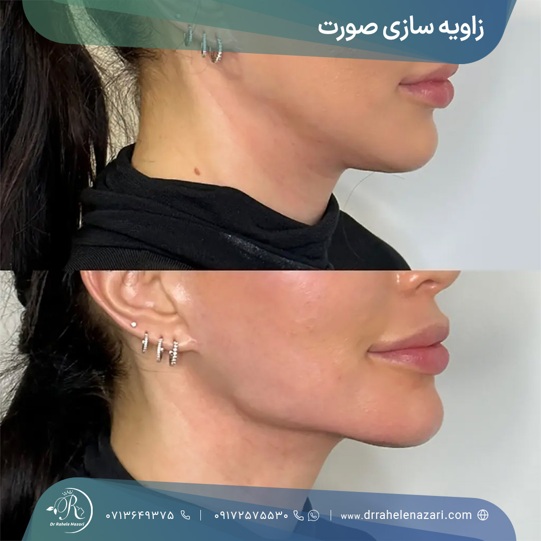نتیجه زاویه سازی صورت نتیجه زاویه سازی صورت