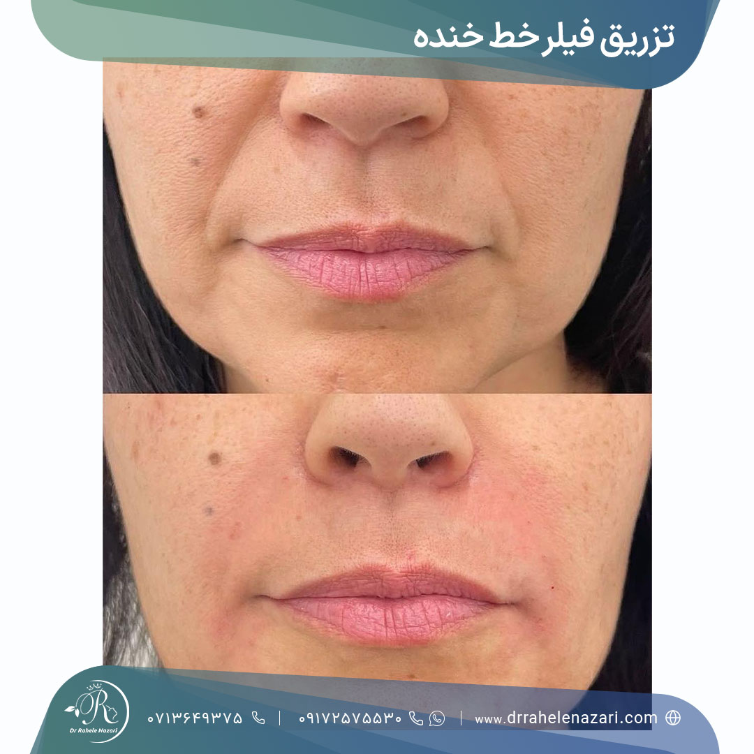 قبل و بعد تزریق فیلر خط خنده قبل و بعد تزریق فیلر خط خنده