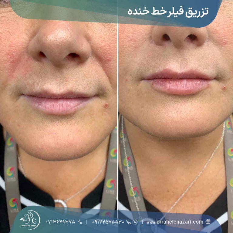 تزریق فیلر خط خنده شیراز