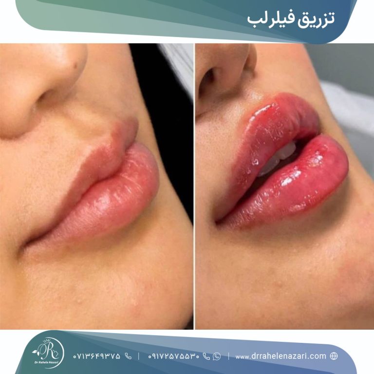 تزریق فیلر لب شیراز