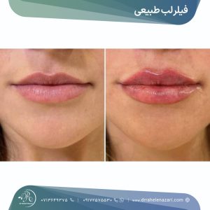 تزریق فیلر لب طبیعی شیراز