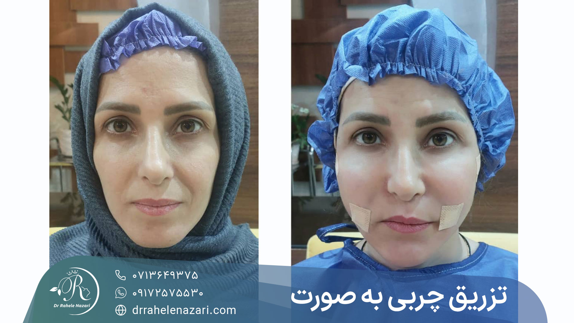 قبل و بعد چربی به صورت در شیراز توسط دکتر راحله نظری قبل و بعد چربی به صورت در شیراز توسط دکتر راحله نظری