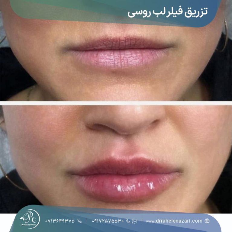 تزریق فیلر لب روسی شیراز