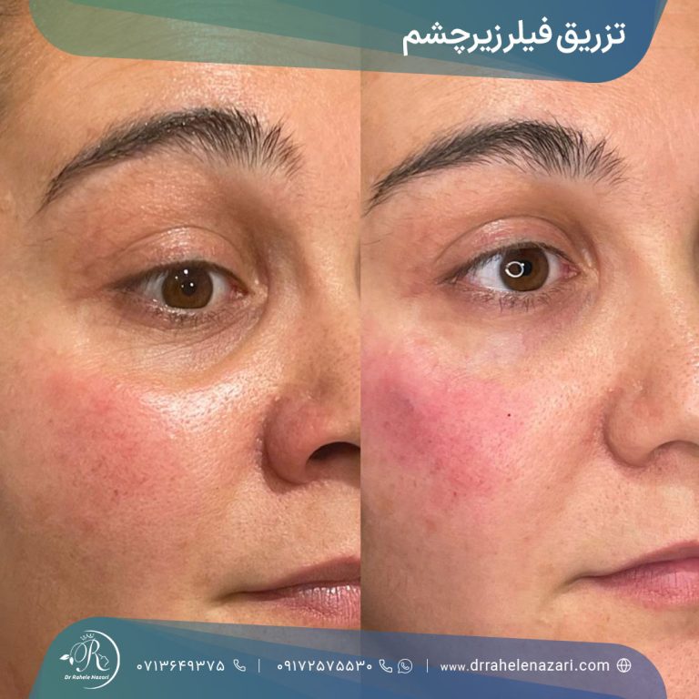 تزریق فیلر زیر چشم شیراز