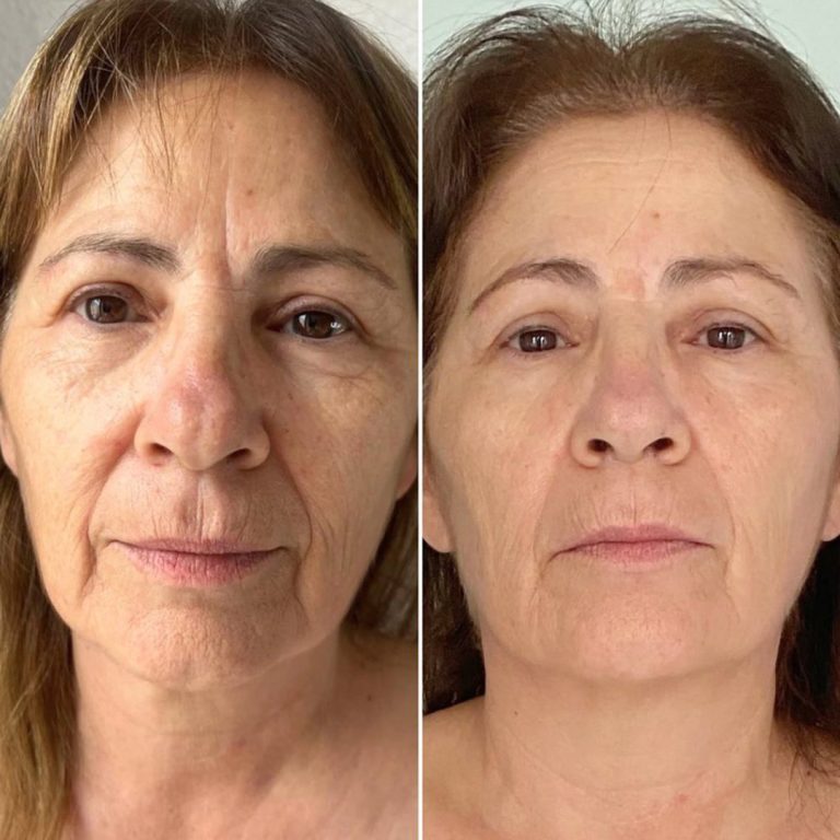 هایفوتراپی صورت شیراز