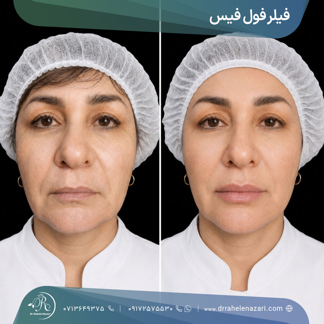 فیلر فول فیس شیراز فیلر فول فیس شیراز
