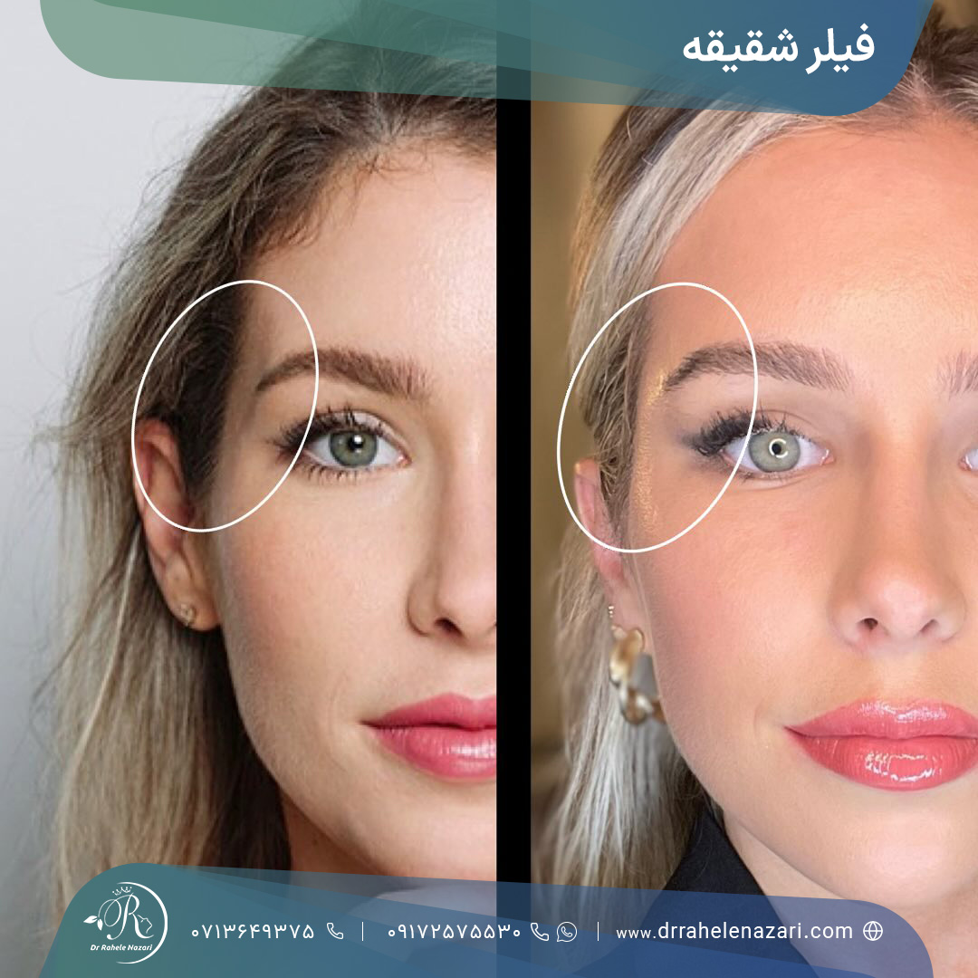 تزریق فیلر شقیقه شیراز تزریق فیلر شقیقه شیراز