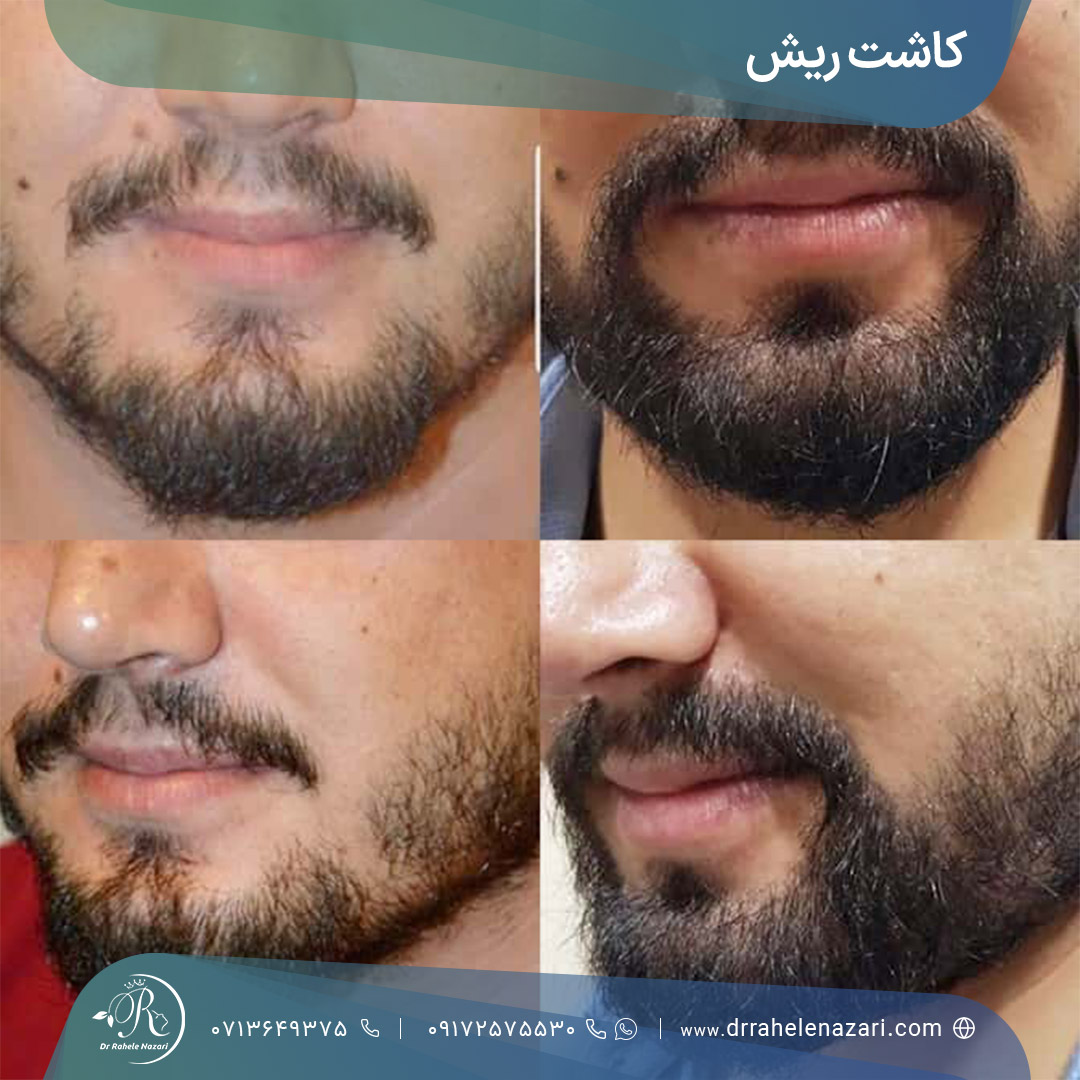 کاشت ریش