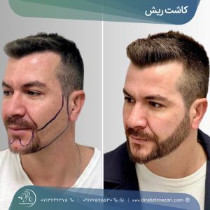 کاشت ریش شیراز