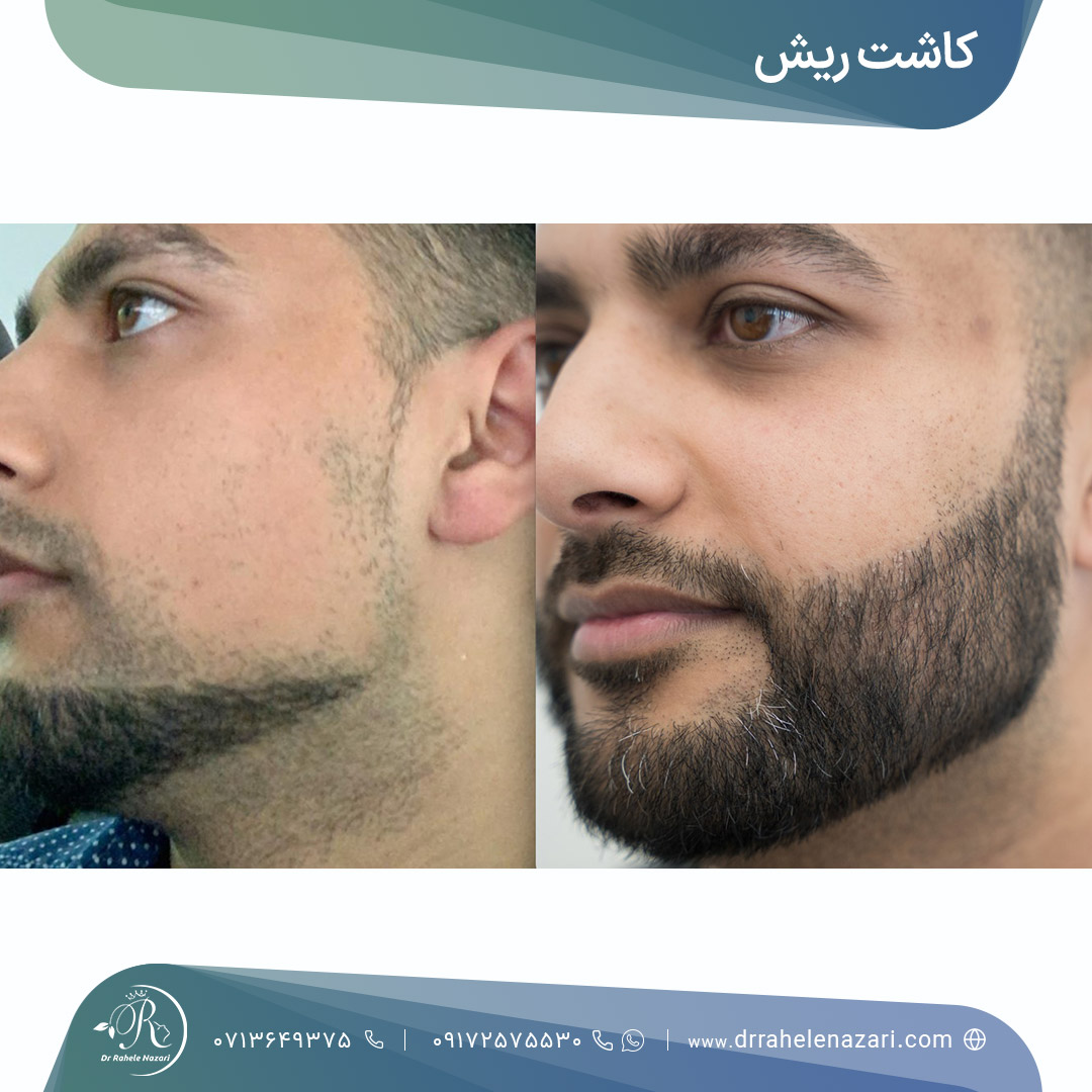 کاشت ریش