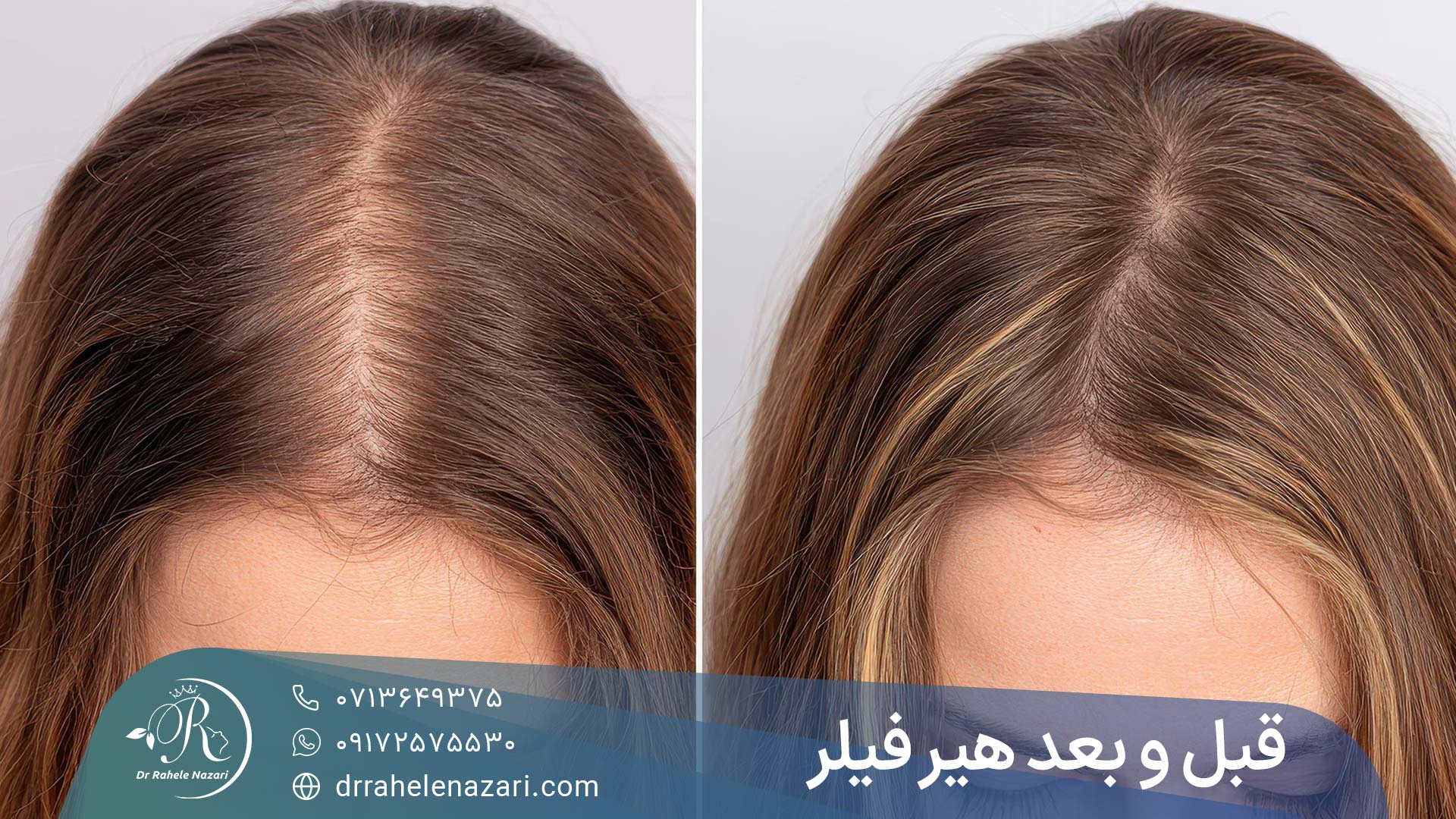 نتیجه تزریق هیر فیلر