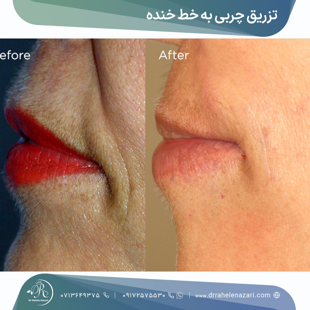 تزریق چربی خط خنده شیراز تزریق چربی خط خنده شیراز