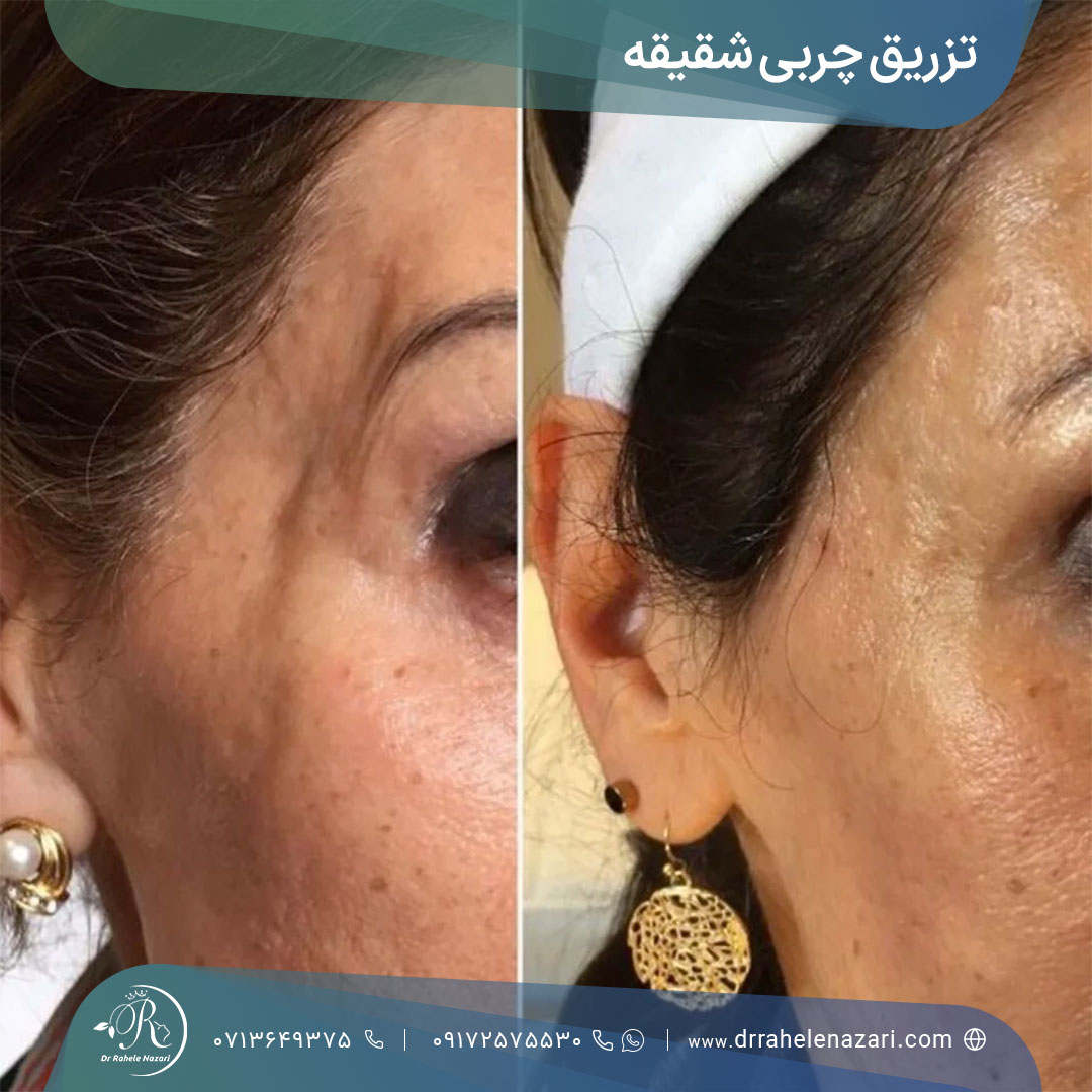 تزریق چربی شقیقه شیراز تزریق چربی شقیقه شیراز