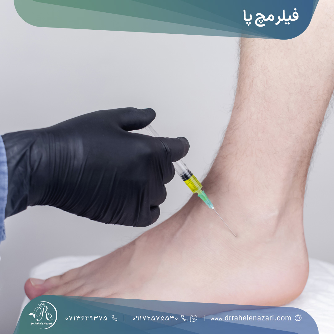 تزریق فیلر مچ پا شیراز