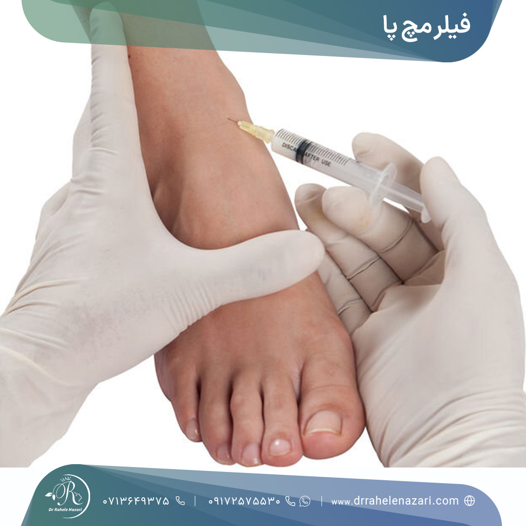 تزریق فیلر مچ پا شیراز