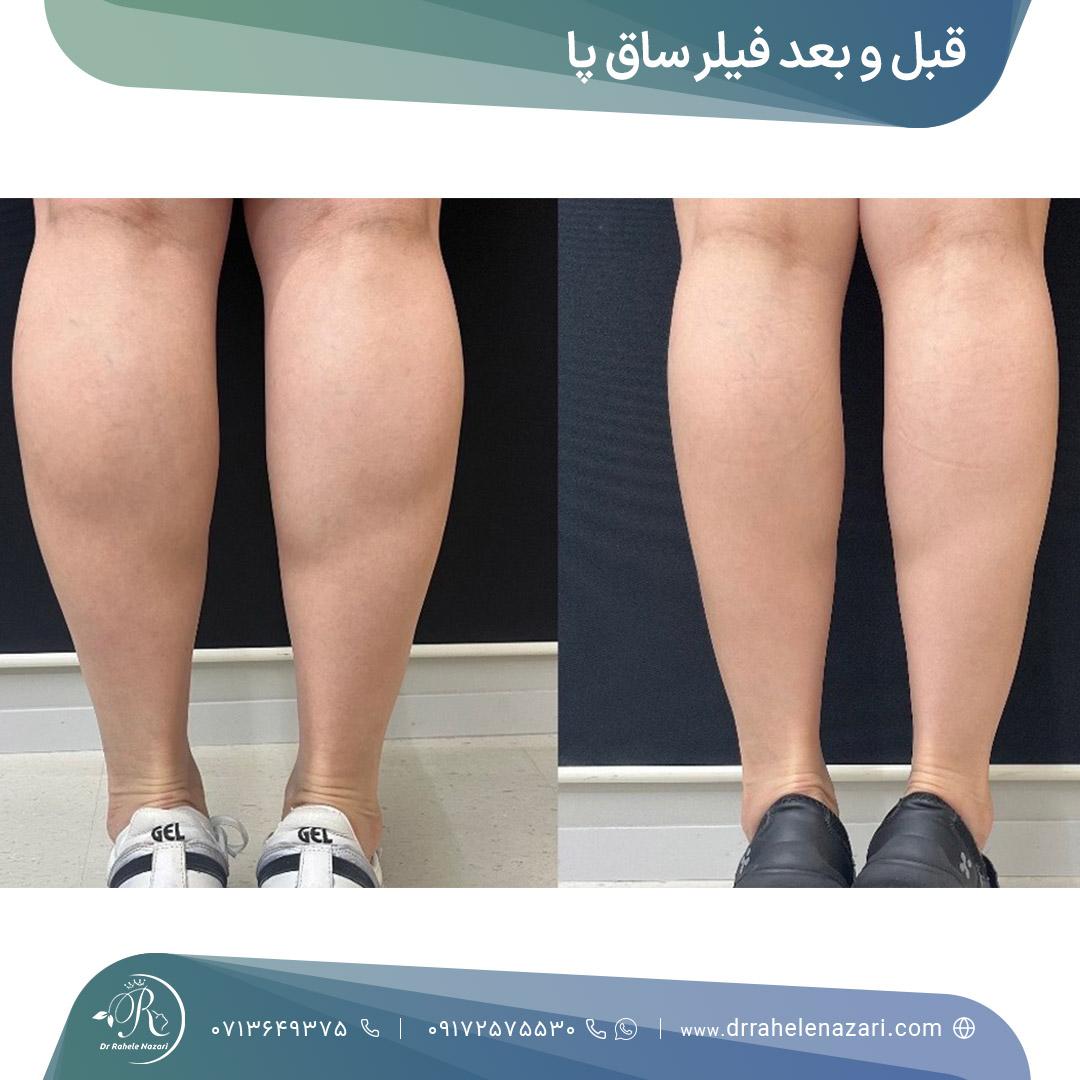 قبل و بعد فیلر ساق پا