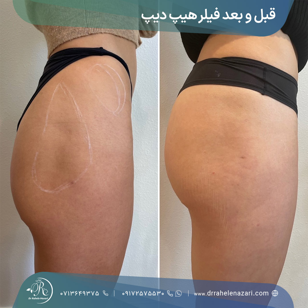 قبل و بعد فیلر هیپ دیپ