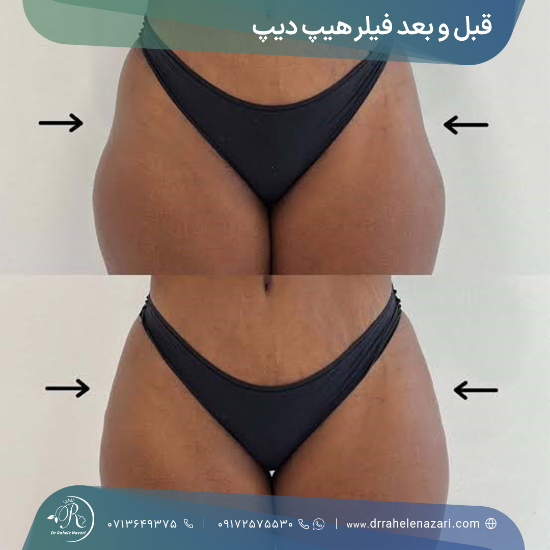 فیلر هیپ دیپ شیراز