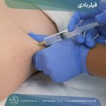 فیلر بادی در شیراز