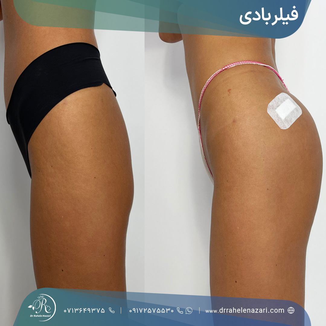 تزریق فیلر باسن برای انجام فیلر بادی