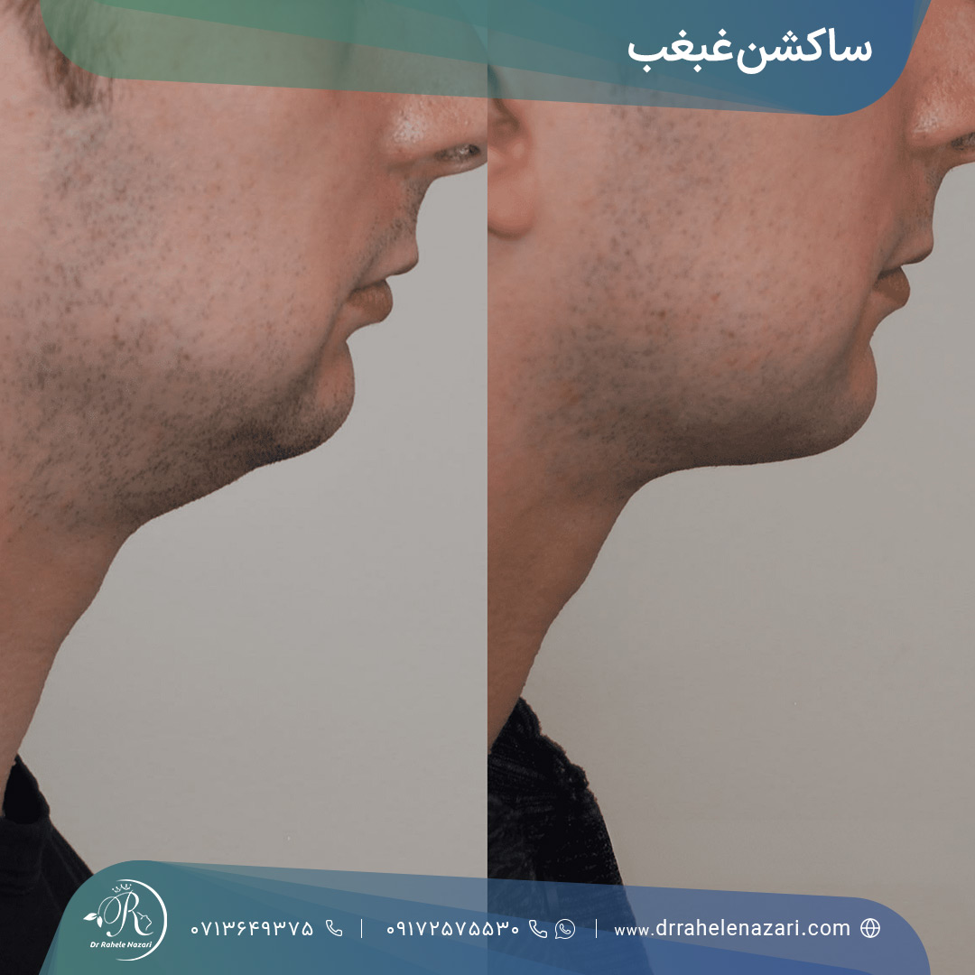 قبل و بعد از انجام ساکشن غبغب آقایان