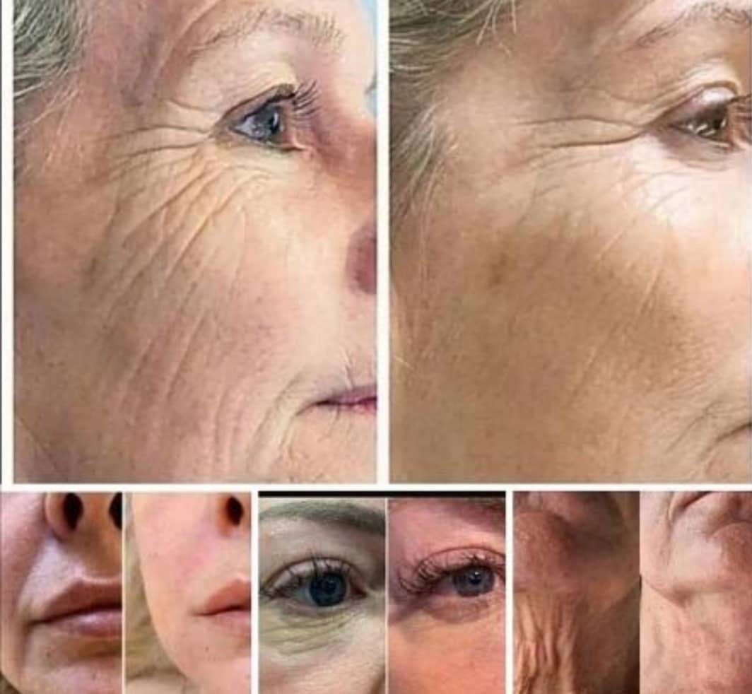 نتیجه تزریق مزوژل در صورت نتیجه تزریق مزوژل در صورت