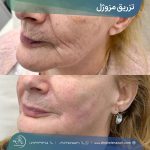 تزریق مزوژل در شیراز