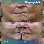 تزریق نخ مایع Plla در شیراز