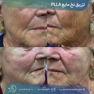 تزریق نخ مایع Plla در شیراز