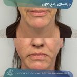 جوانسازی با نخ کلاژن در شیراز